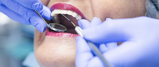 Best Emergency Dentist for Lost Fillings or Crowns in Goshen, KY